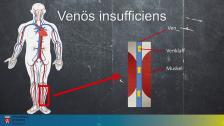 Venösa bensår - SSK